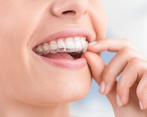 Invisalign provider in Gurgaon